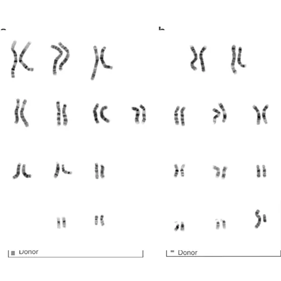 Chromosome - Karyotyping (Husband)